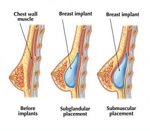 w7_implantplacement-300x262